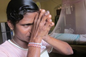 A few old men and women have been living at the Hendala Leprosy Hospital in Sri Lanka for most of their lives.